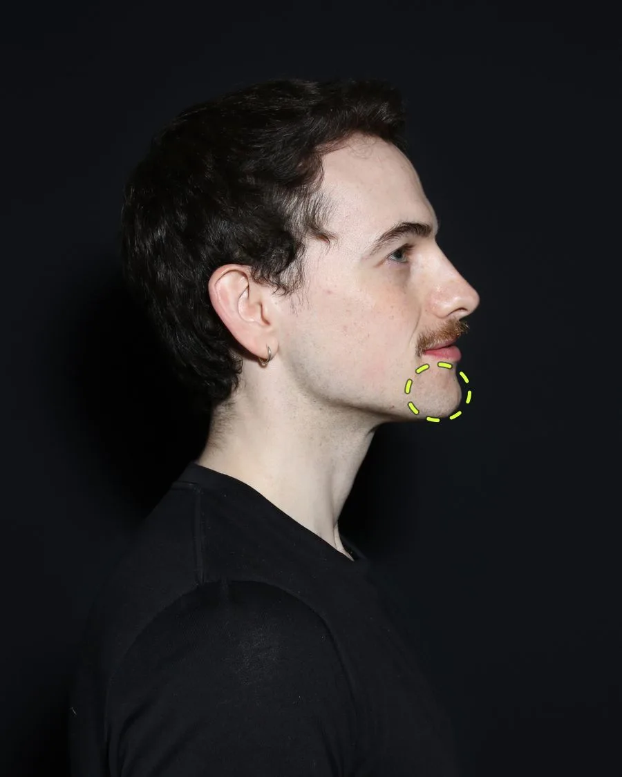 A patient photograph with the chin filler area marked