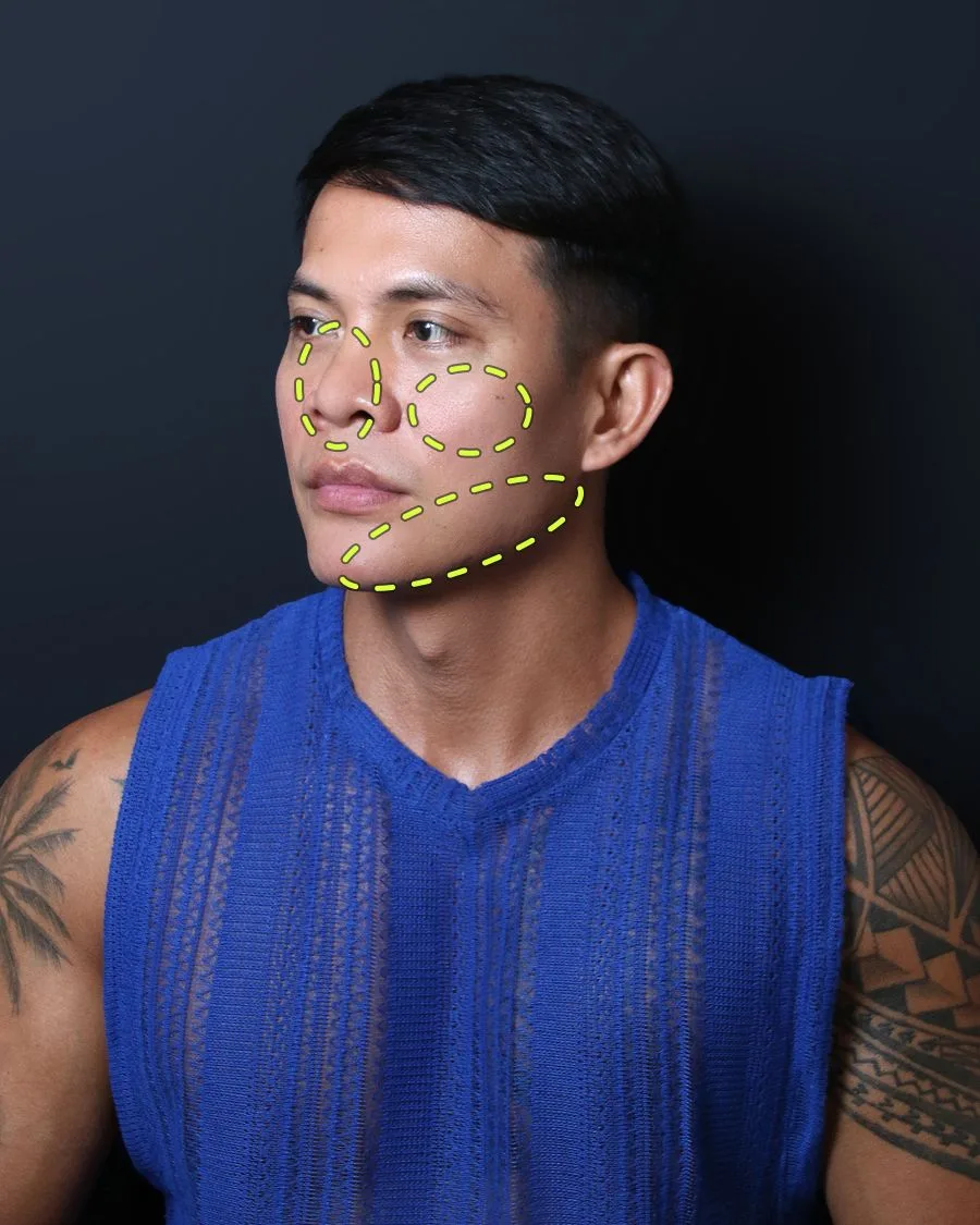 A patient photograph with the jaw, cheek and nose treatment areas marked