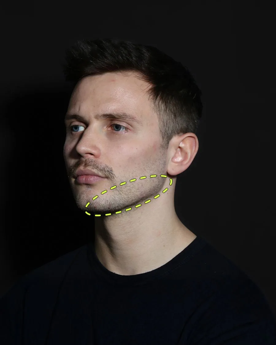 A patient photograph with the jawline filler area marked